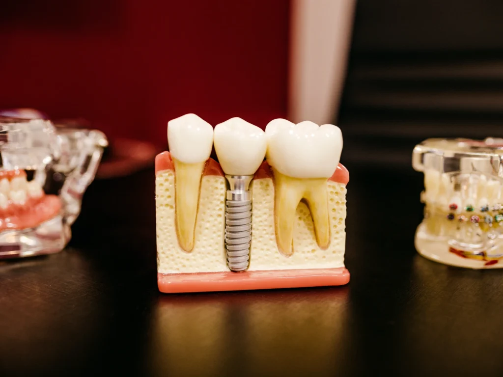 model of a single tooth dental implant | cost of dental implants in Punta Gorda, FL