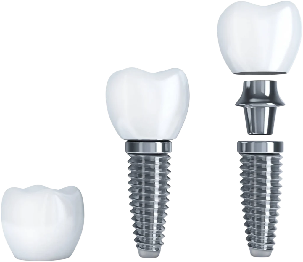 Model of a single tooth dental implant showing the implant post, abutment, and crown