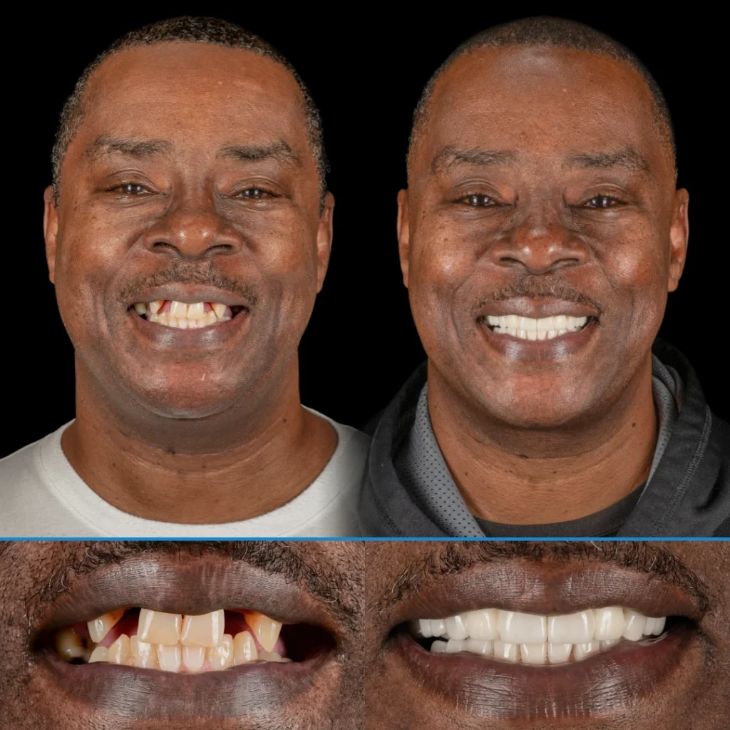Dental implants before and after photo in Punta Gorda, FL at Dolecki Advanced Dentistry & Implants